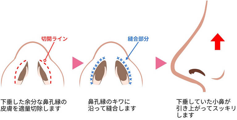 小鼻縮小で効果が出やすい・出にくいがある？