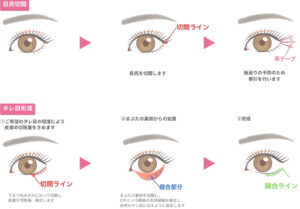 タレ目形成と目尻切開のイラスト