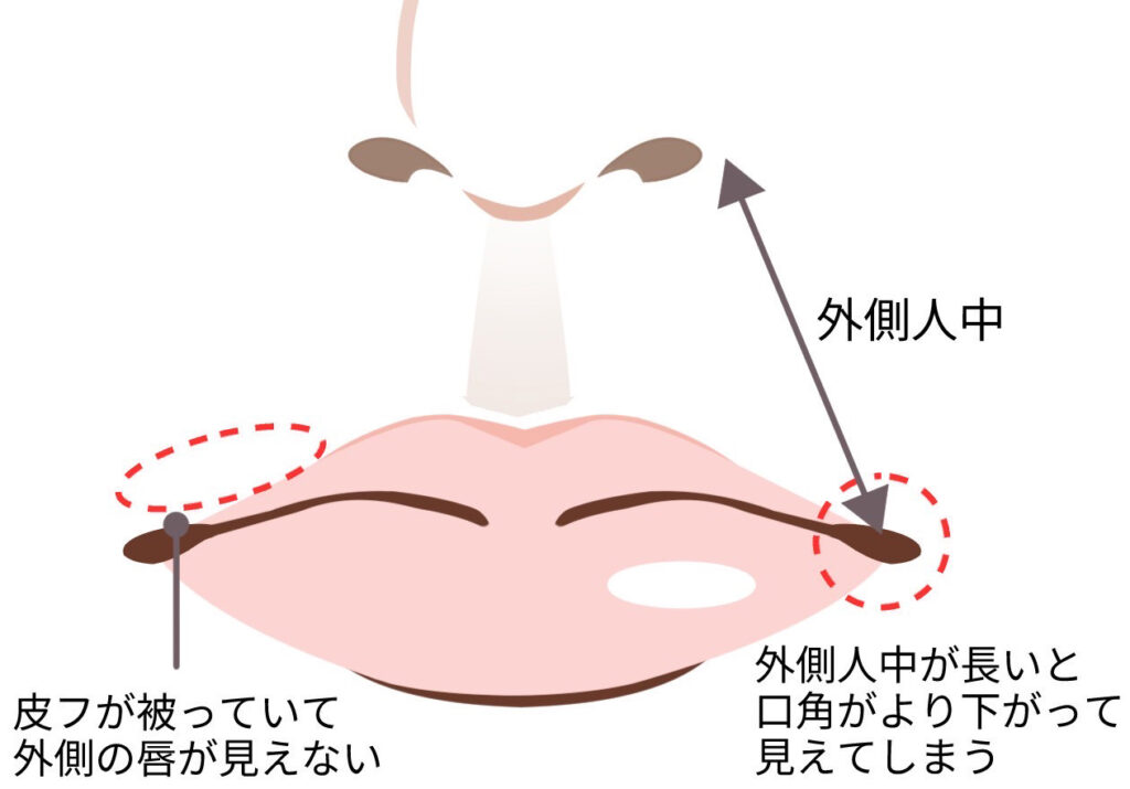 人中短縮(Cカール形成)で若々しく可愛らしい口元へ|京都駅前美容外科