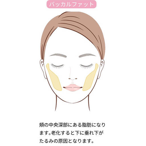 バッカルファット除去