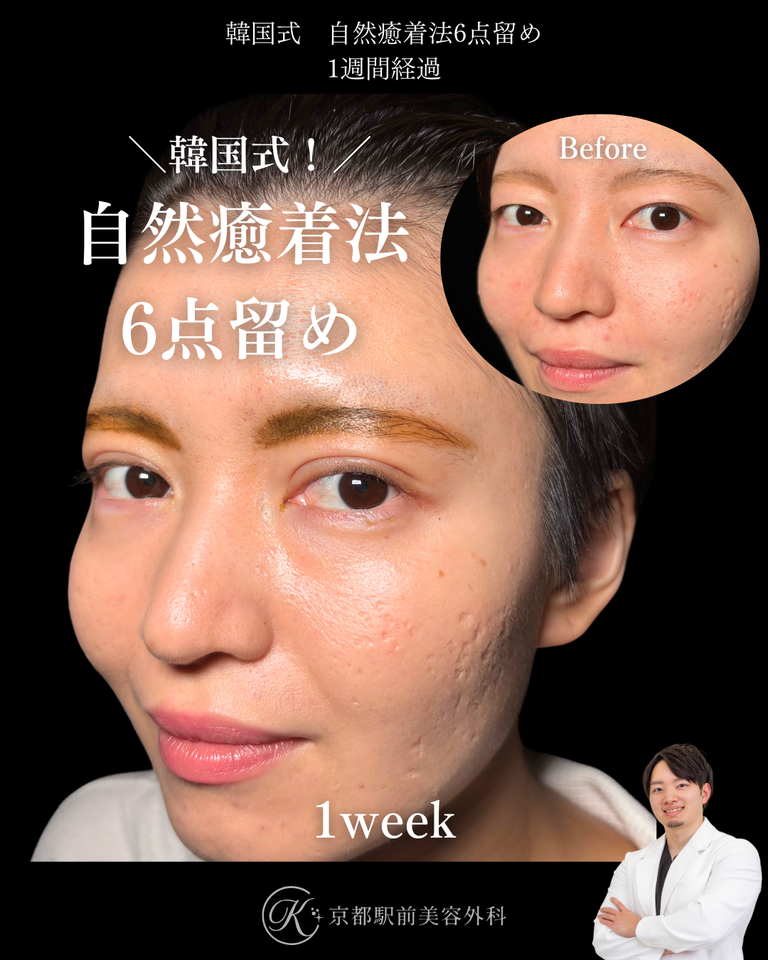 二重埋没法(自然癒着法法6点留め)の1週間後経過写真(京都駅前美容外科の症例)