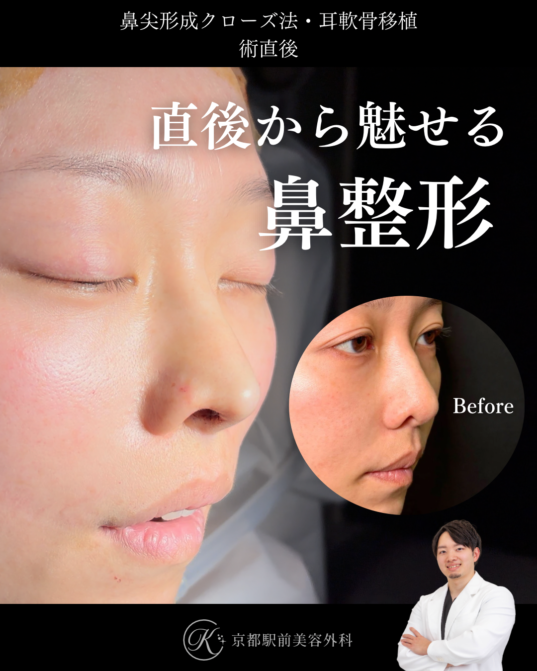 鼻尖形成クローズ法と耳軟骨移植の術直後写真（京都駅前美容外科の鼻整形症例）