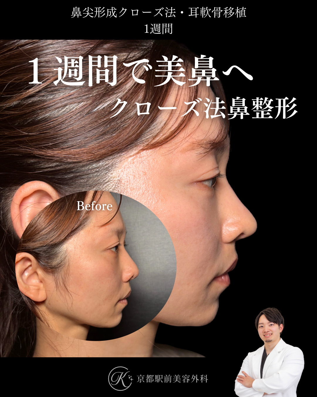 鼻尖形成クローズ法と耳軟骨移植の1週間後経過症例写真（京都駅前美容外科の鼻整形症例）