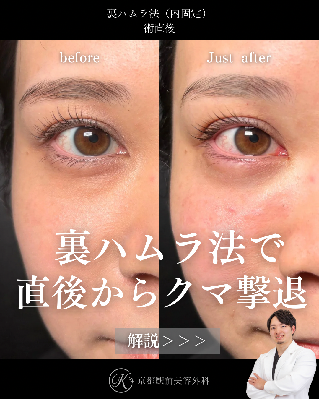 裏ハムラ法（クマ取り）の術直後写真（京都駅前美容外科の症例）