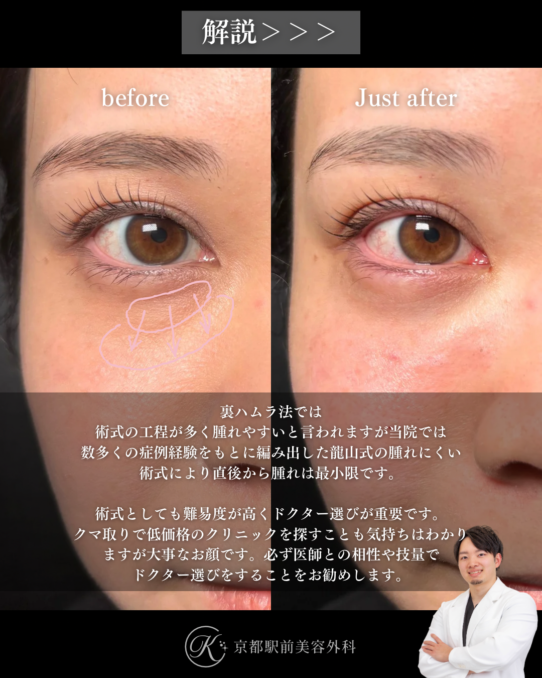 裏ハムラ法（クマ取り）の術直後写真とその詳細な解説文（京都駅前美容外科の症例）