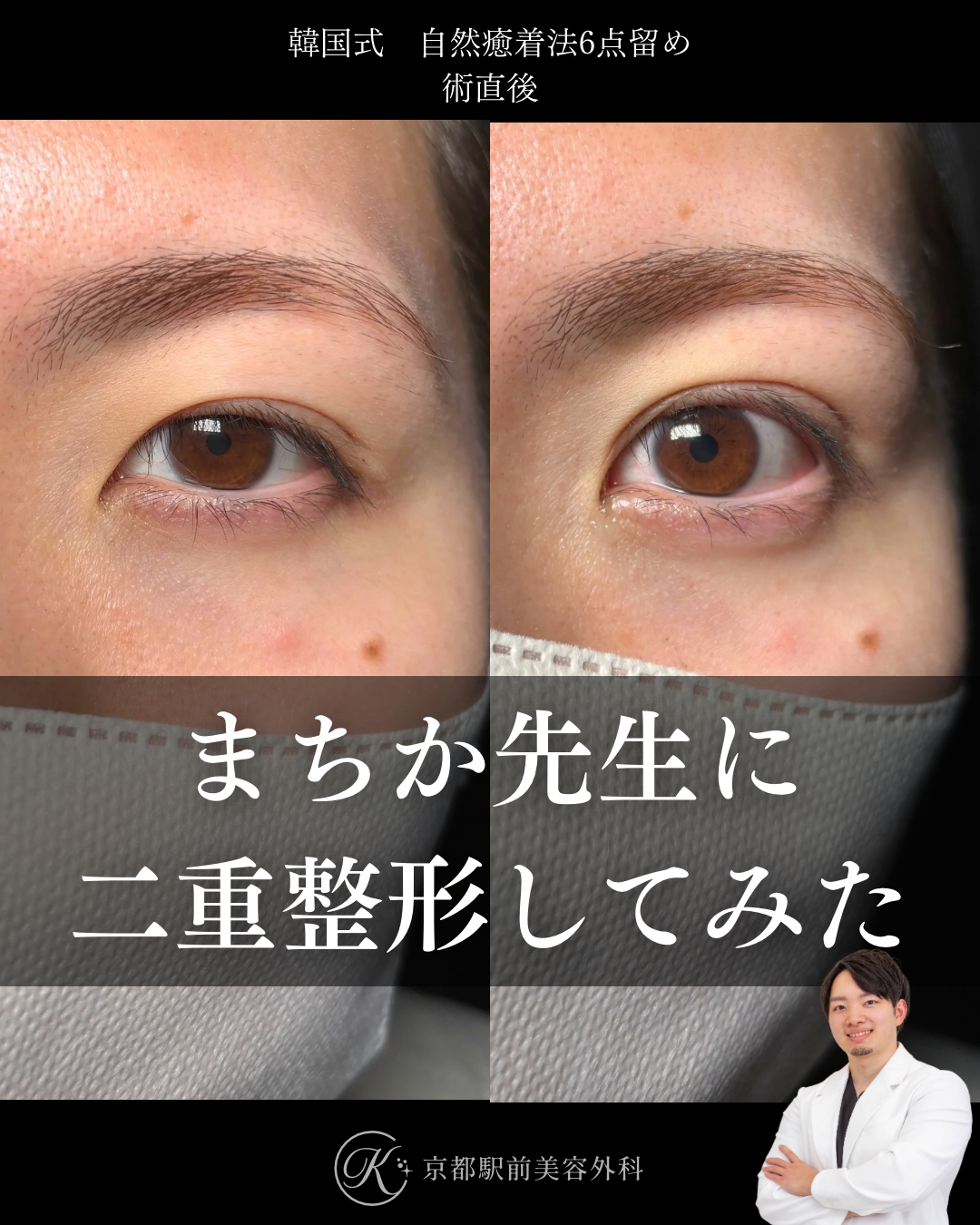 二重埋没法（自然癒着法法6点留め）の術直後写真（京都駅前美容外科の症例）