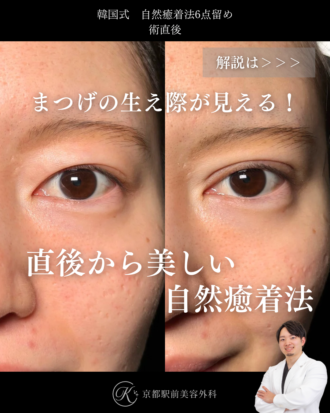 二重埋没法（自然癒着法法6点留め）の術直後写真（京都駅前美容外科の症例）