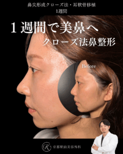 鼻尖形成クローズ法と耳軟骨移植の1週間後経過症例写真（京都駅前美容外科の鼻整形症例）