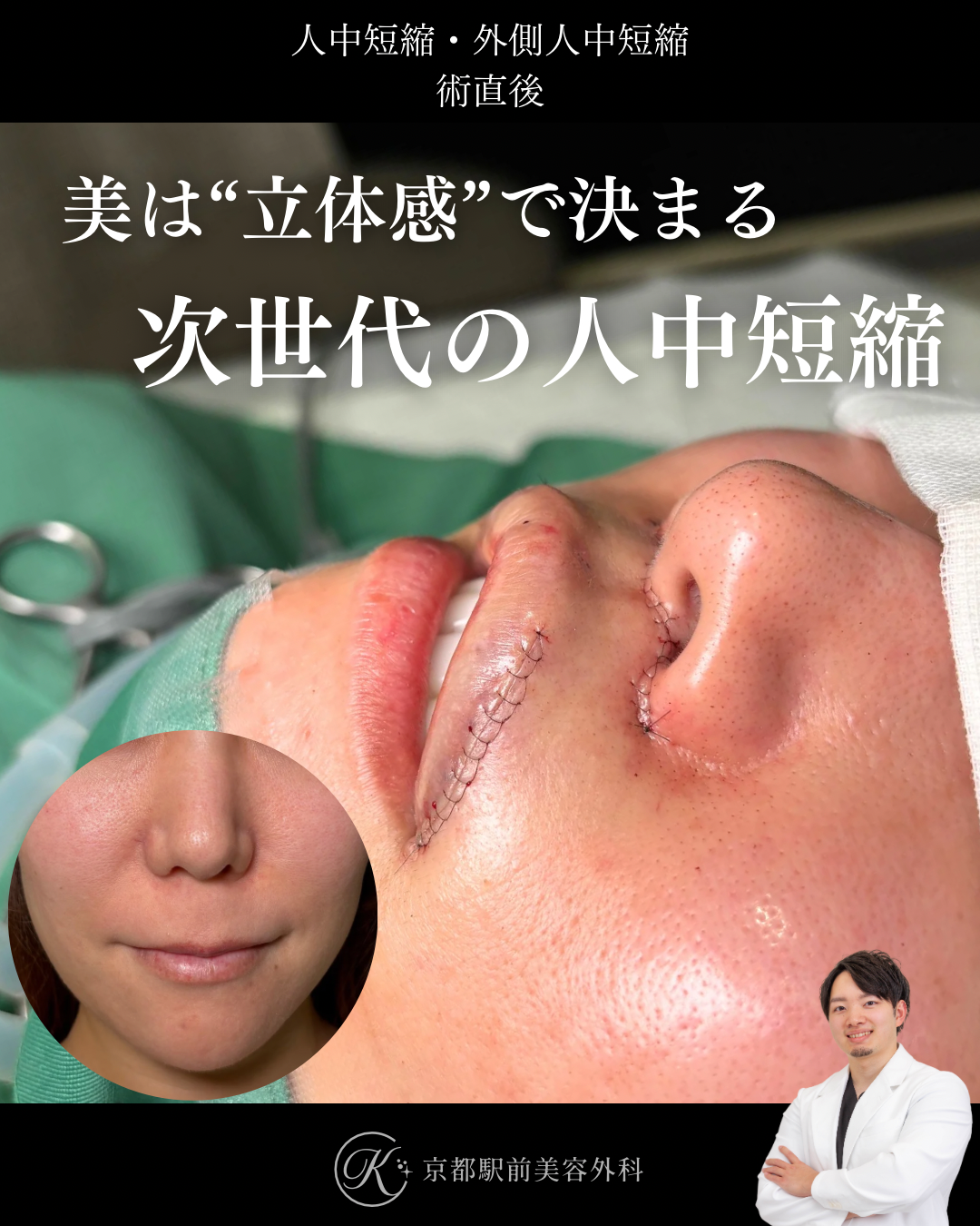 人中短縮と外側人中短縮の術直後写真（京都駅前美容外科の症例）