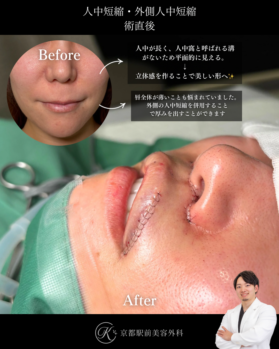 人中短縮と外側人中短縮の術直後写真とその解説（京都駅前美容外科の症例）