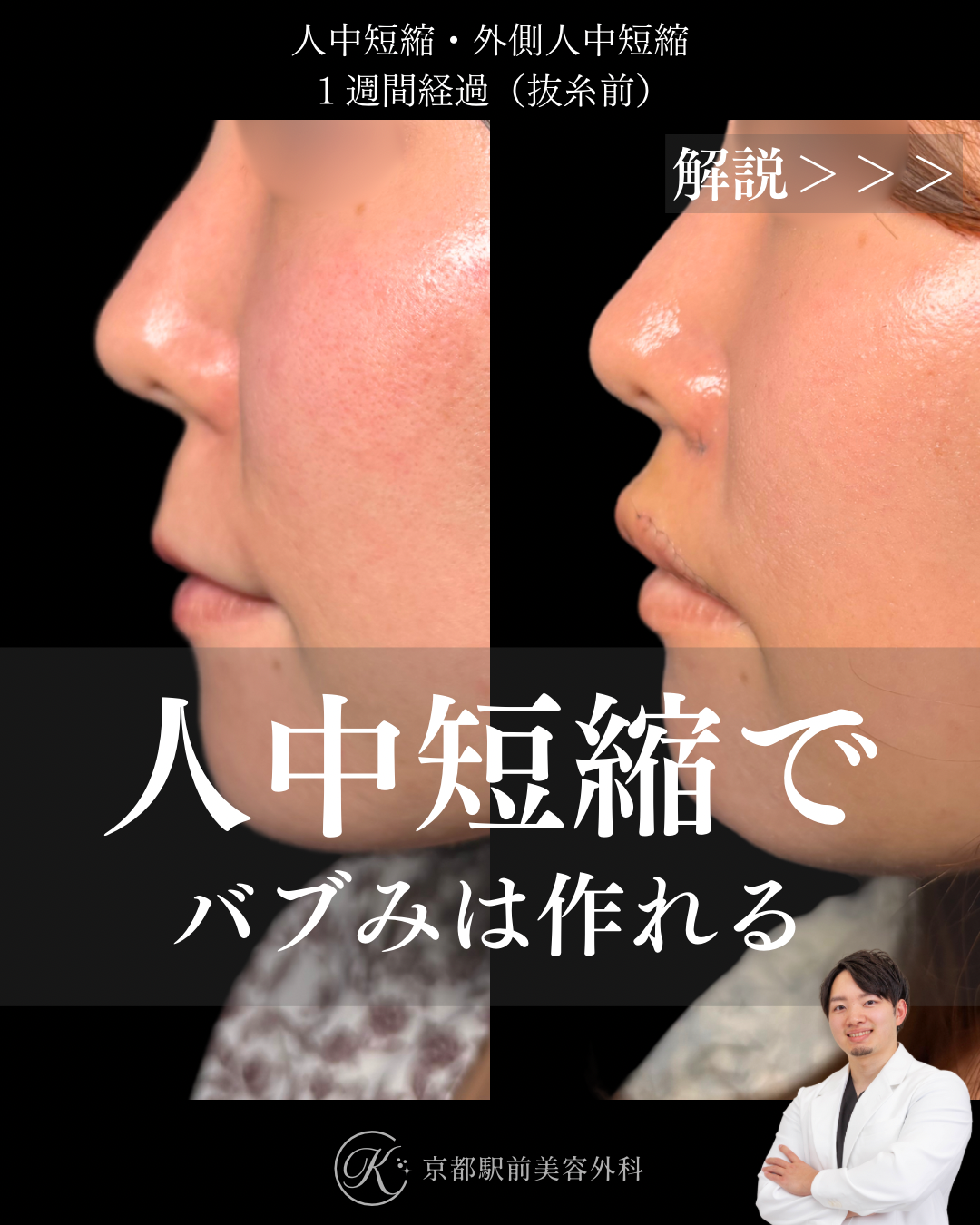 人中短縮と外側人中短縮の術後１週間経過の画像（京都駅前美容外科の症例）