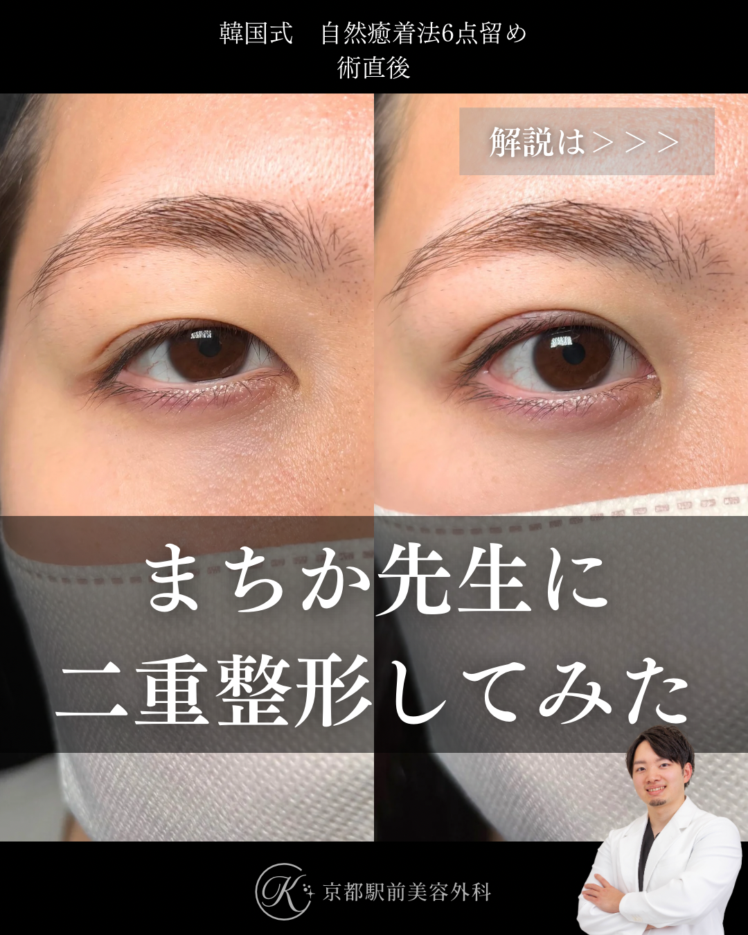 二重埋没法（自然癒着法法6点留め）の術直後写真（京都駅前美容外科の症例）