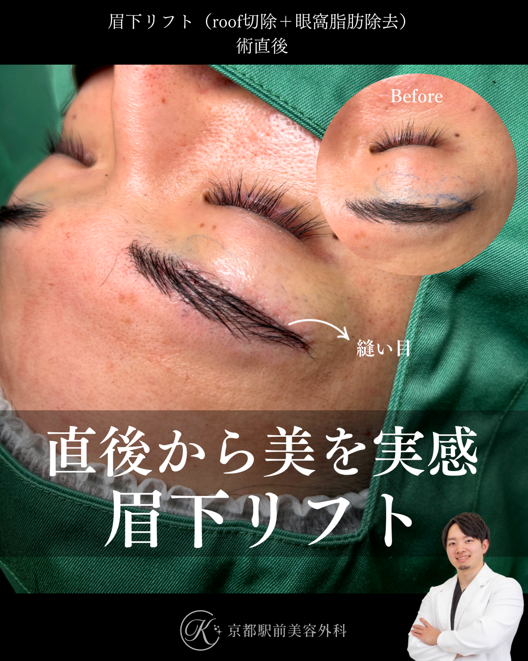眉下切開の術直後写真（roof切除・眼窩脂肪除去）（京都駅前美容外科の目元症例）