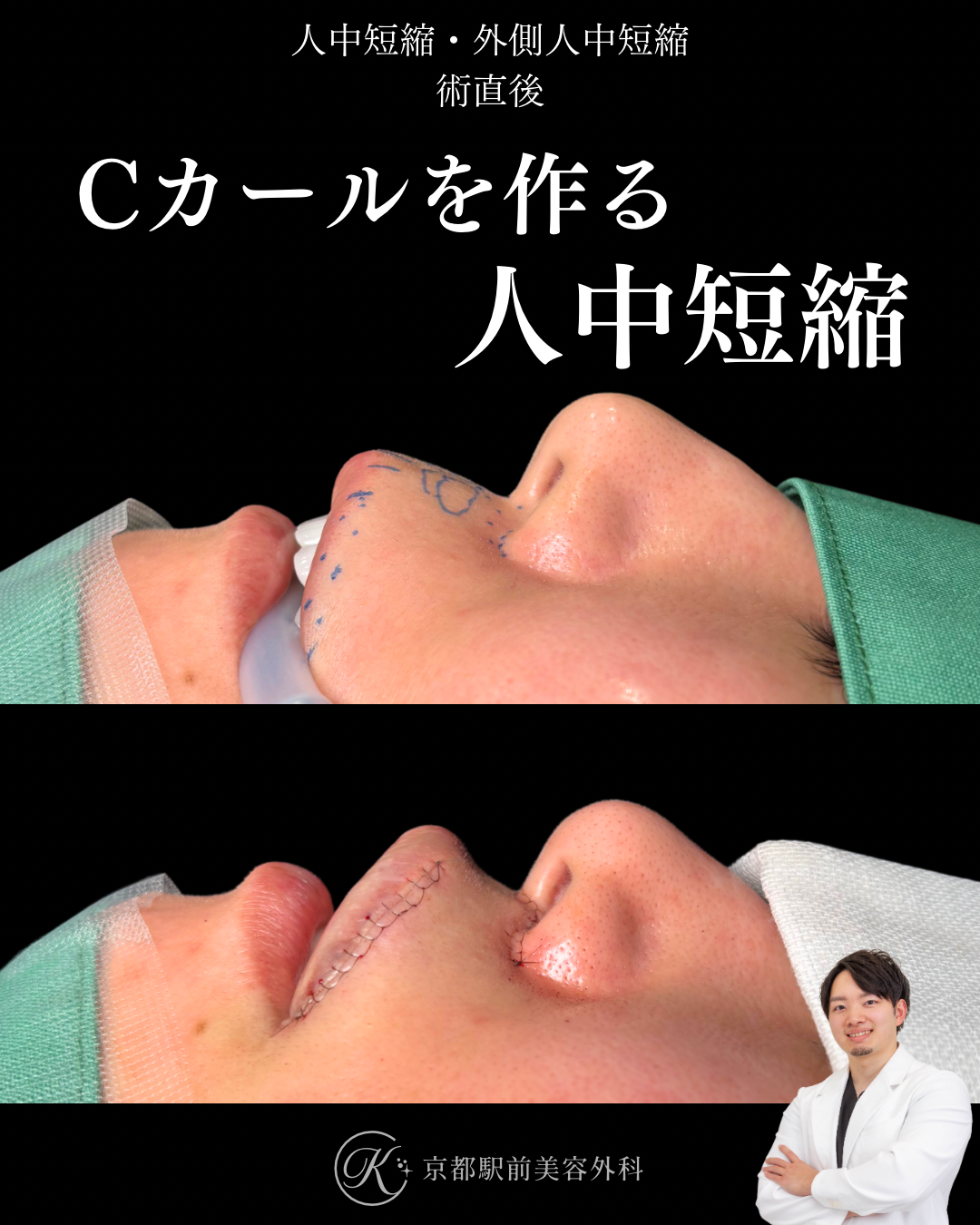 人中短縮と外側人中短縮の術直後写真（京都駅前美容外科の症例）
