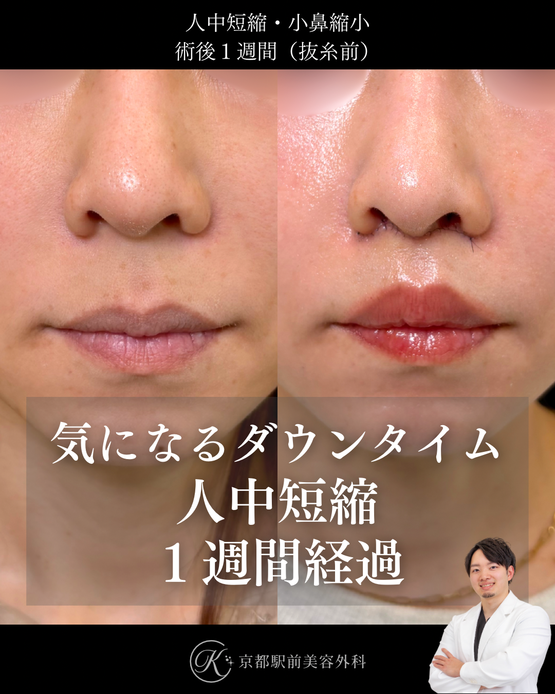人中短縮の１週間後ダウンタイム経過写真（京都駅前美容外科の症例）