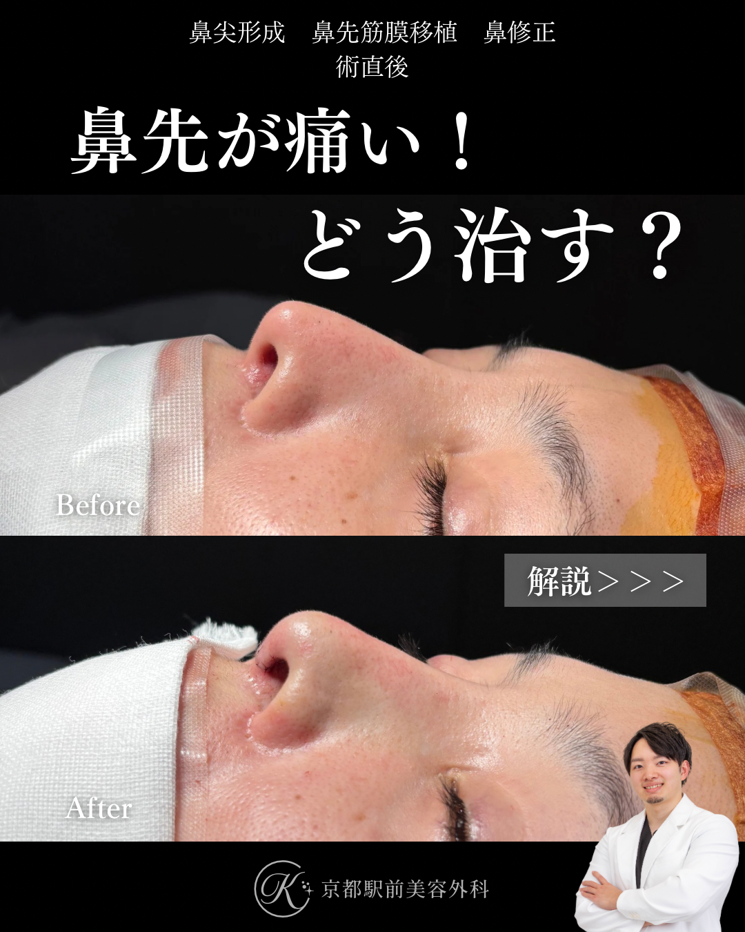 肋軟骨鼻整形の他院修正症例（京都駅前美容外科の症例）