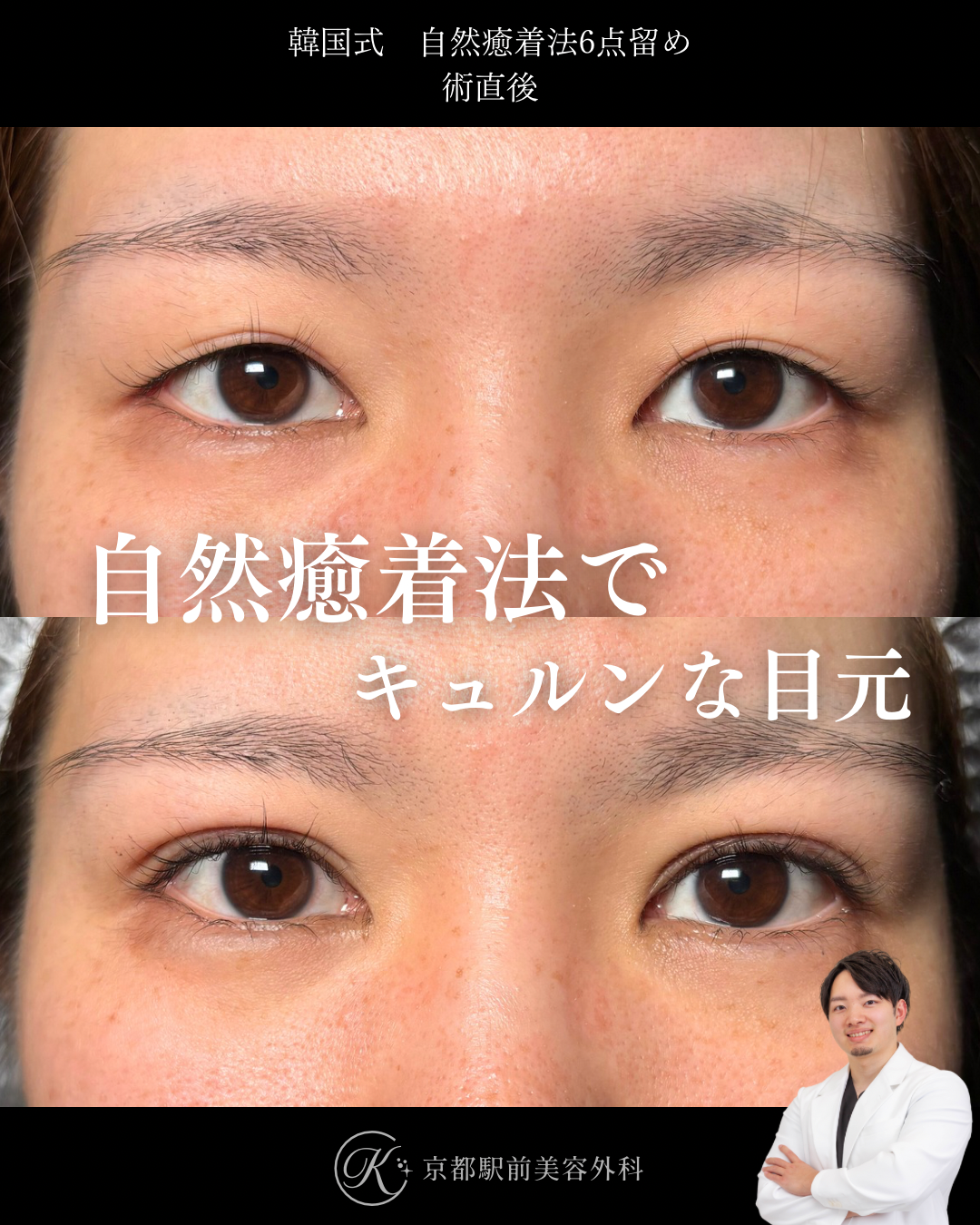 二重埋没法（自然癒着法法6点留め）の術直後写真（京都駅前美容外科の症例）