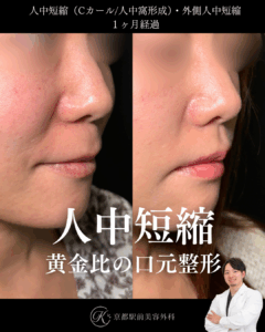 人中短縮と外側人中短縮の1ヶ月経過写真(京都駅前美容外科の症例)
