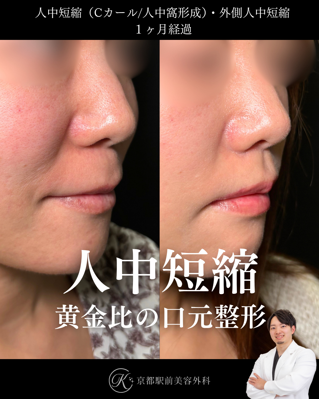人中短縮と外側人中短縮の1ヶ月経過写真（京都駅前美容外科の症例）