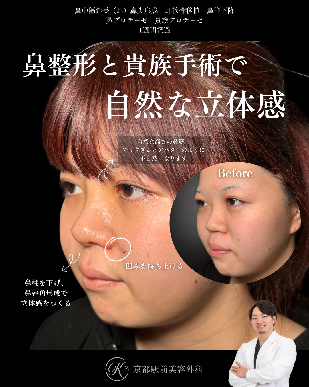 鼻整形（鼻尖形成オープン法・耳軟骨移植・鼻中隔延長術・プロテーゼ）と貴族手術（基部プロテーゼ）の１週間後経過写真（京都駅前美容外科の症例）