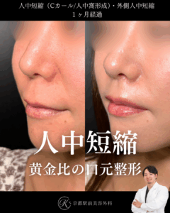 人中短縮と外側人中短縮の1ヶ月後経過の写真(京都駅前美容外科の症例)