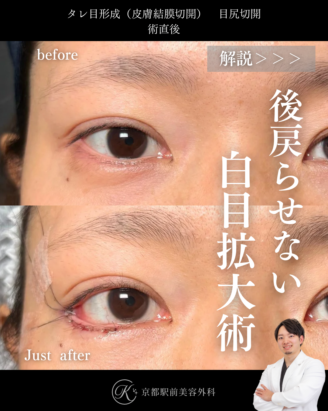 タレ目形成と目尻切開の術直後写真（京都駅前美容外科の症例）