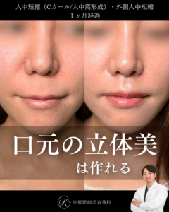人中短縮と外側人中短縮の1ヶ月後経過の写真(京都駅前美容外科の症例)