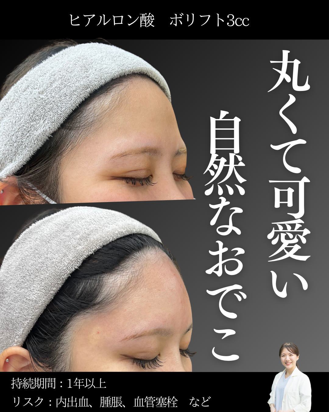 額ヒアルロン酸症例（京都駅前美容外科の症例）