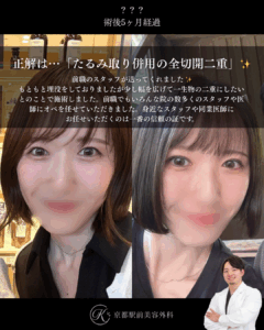 たるみ取り併用全切開二重術の症例写真(京都駅前美容外科の症例)