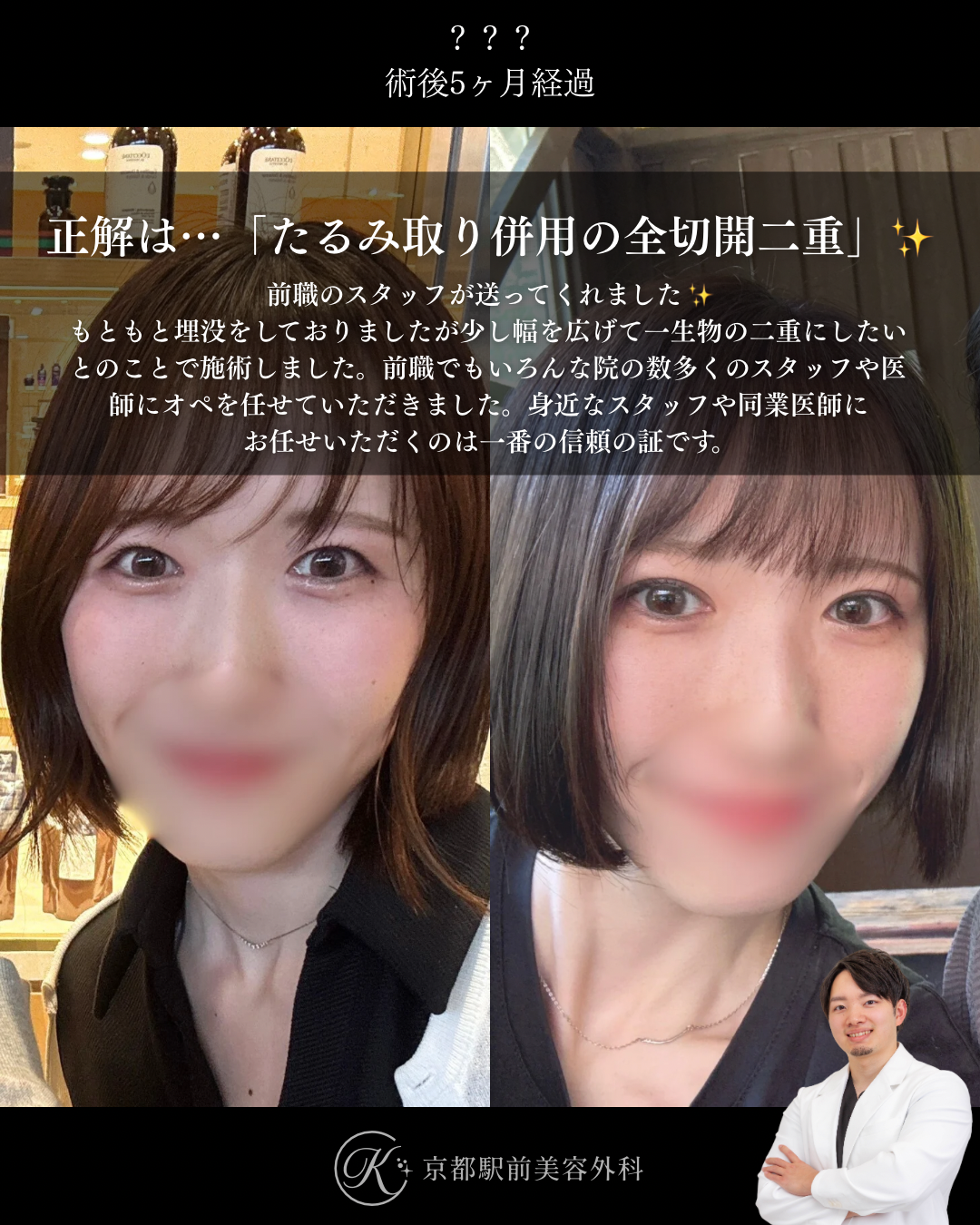 たるみ取り併用全切開二重術の症例写真（京都駅前美容外科の症例）