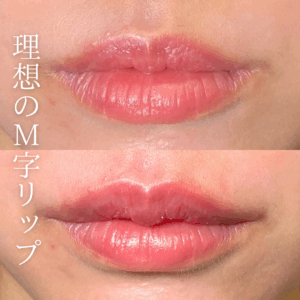 唇ヒアルロン酸で口角挙上