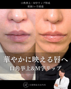 口角挙上術とM字リップ形成の１ヶ月後経過症例写真（京都駅前美容外科の症例）