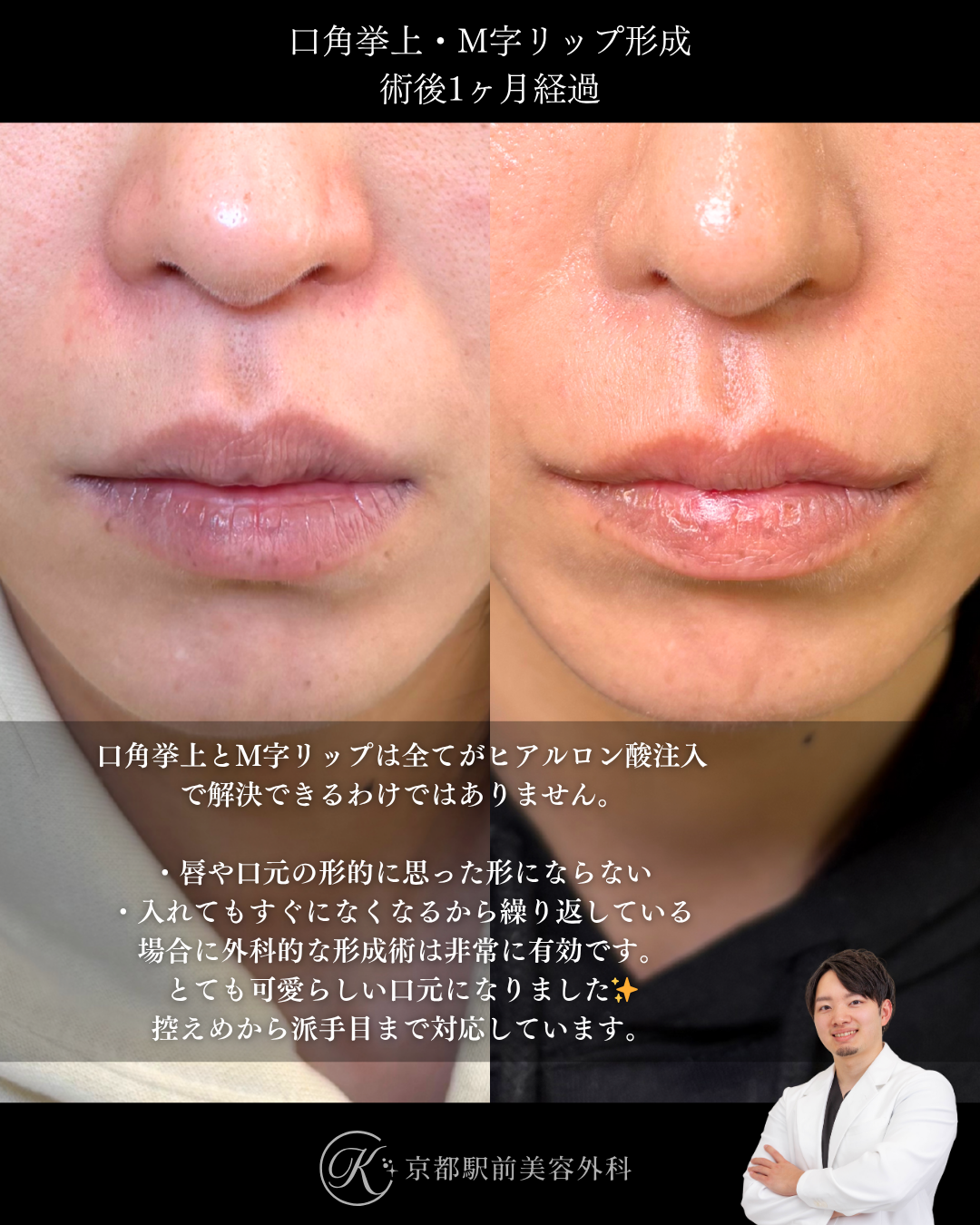 口角挙上術とM字リップ形成の１ヶ月後経過症例写真（京都駅前美容外科の症例）