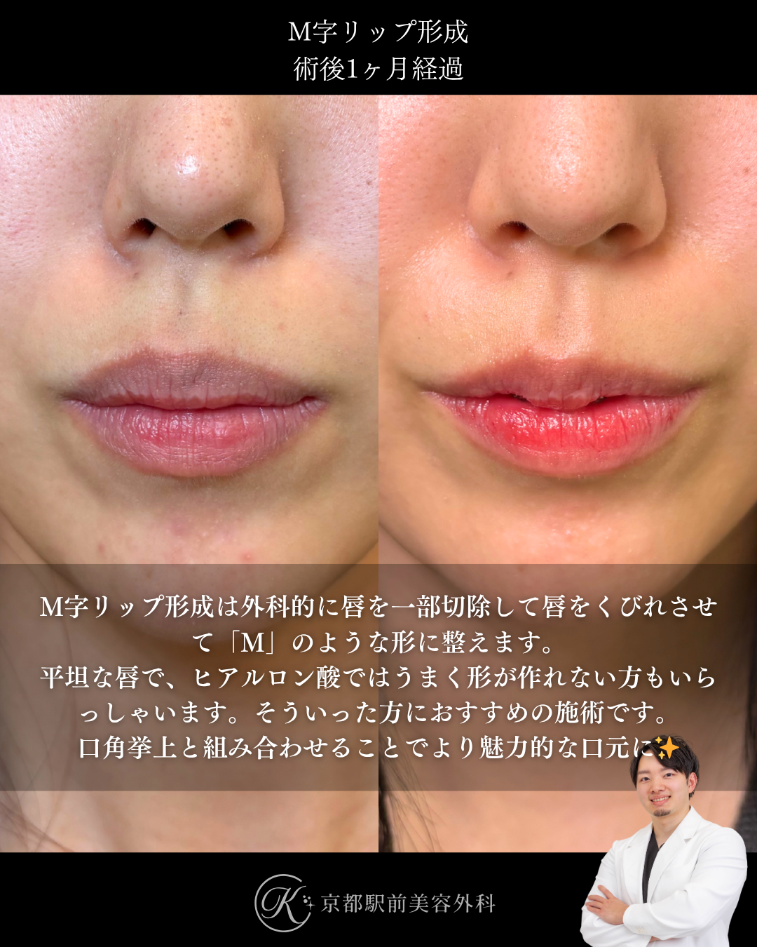 M字リップ形成の１ヶ月後経過症例写真（京都駅前美容外科の症例）