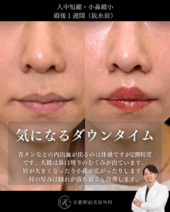 人中短縮の1週間後ダウンタイム経過写真(京都駅前美容外科の症例)