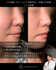 人中短縮と外側人中短縮の1ヶ月経過写真(京都駅前美容外科の症例)