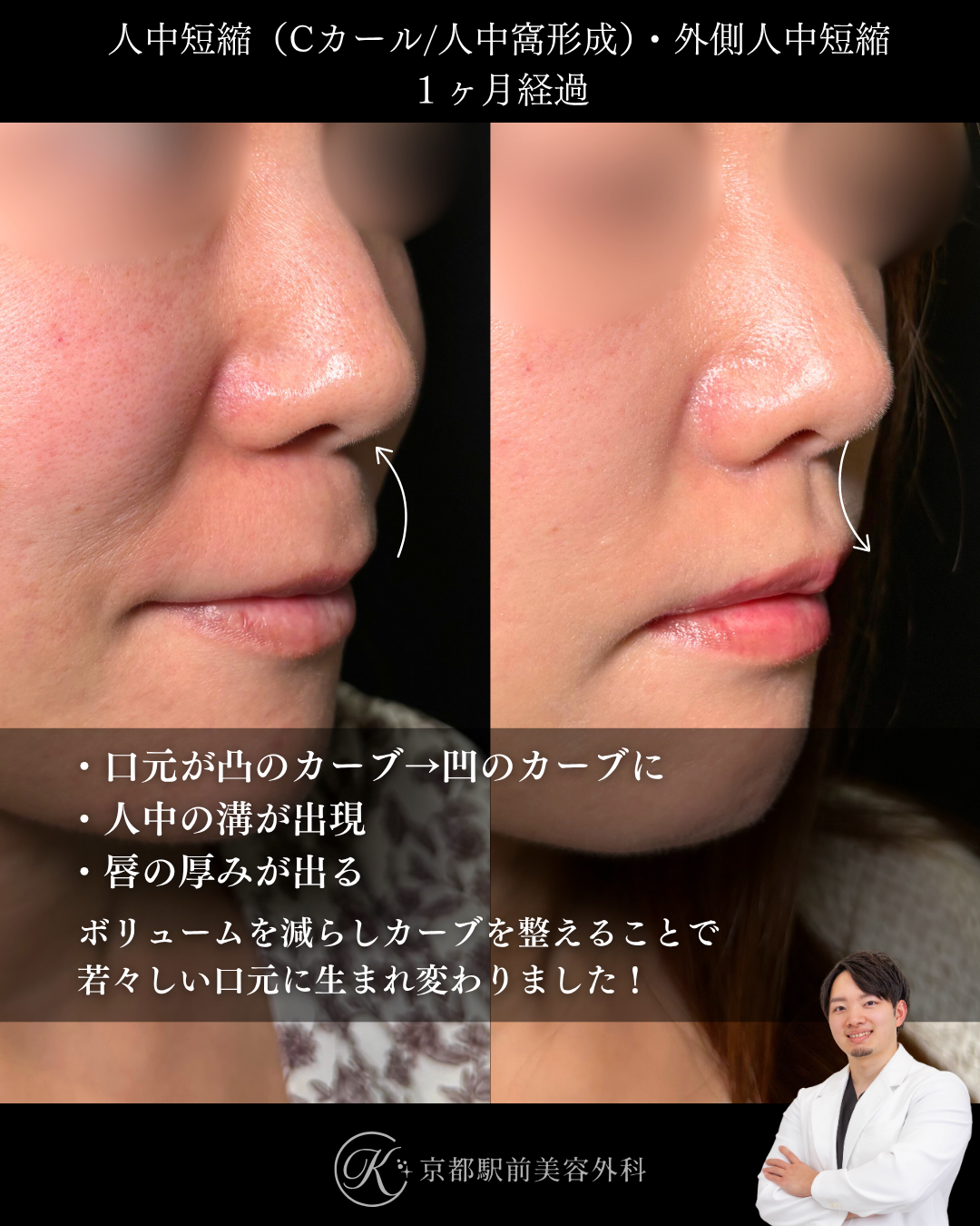 人中短縮と外側人中短縮の1ヶ月経過写真（京都駅前美容外科の症例）