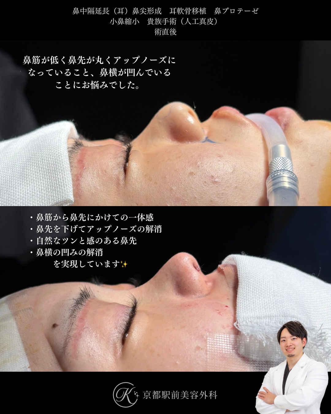 鼻整形（鼻尖形成オープン法・耳軟骨移植・鼻中隔延長術・鼻プロテーゼ・小鼻縮小）と貴族手術（人工真皮）の術直後写真（京都駅前美容外科の症例）