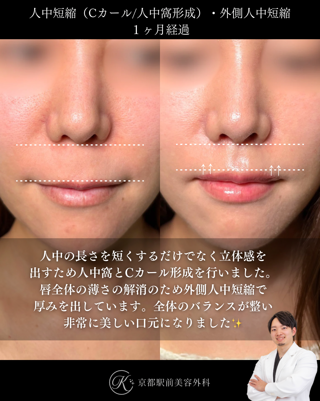 人中短縮と外側人中短縮の1ヶ月後経過の写真（京都駅前美容外科の症例）
