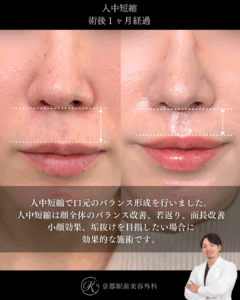 人中短縮の術後経過写真（京都駅前美容外科の症例）