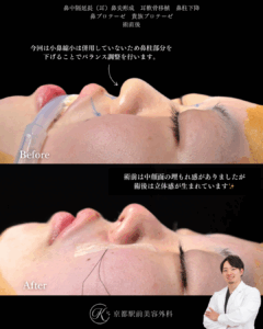 鼻整形(鼻尖形成オープン法・耳軟骨移植・鼻中隔延長術・プロテーゼ)と貴族手術(基部プロテーゼ)の術直後写真(京都駅前美容外科の症例)