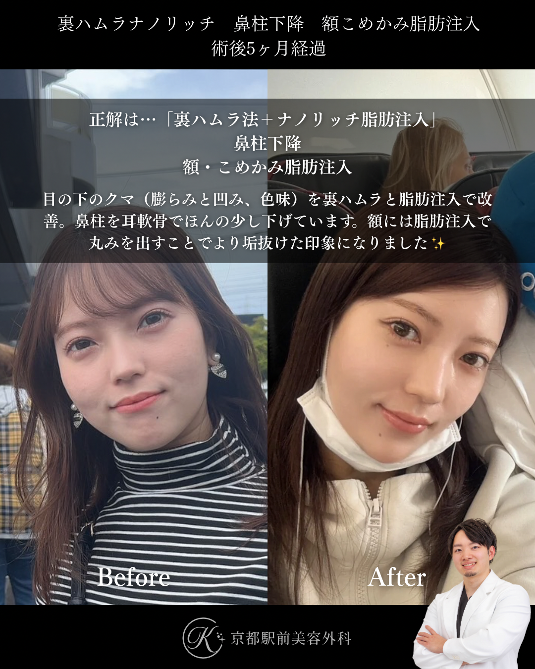 裏ハムラ法（クマ取り）＋目の下ナノリッチ脂肪注入、鼻柱下降、額の脂肪注入の術後経過写真（京都駅前美容外科の症例）
