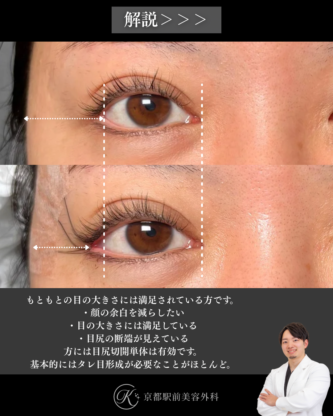 目尻切開の術直後写真（京都駅前美容外科の症例）
