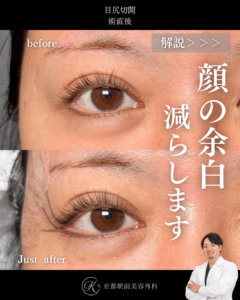 目尻切開の術直後写真(京都駅前美容外科の症例)
