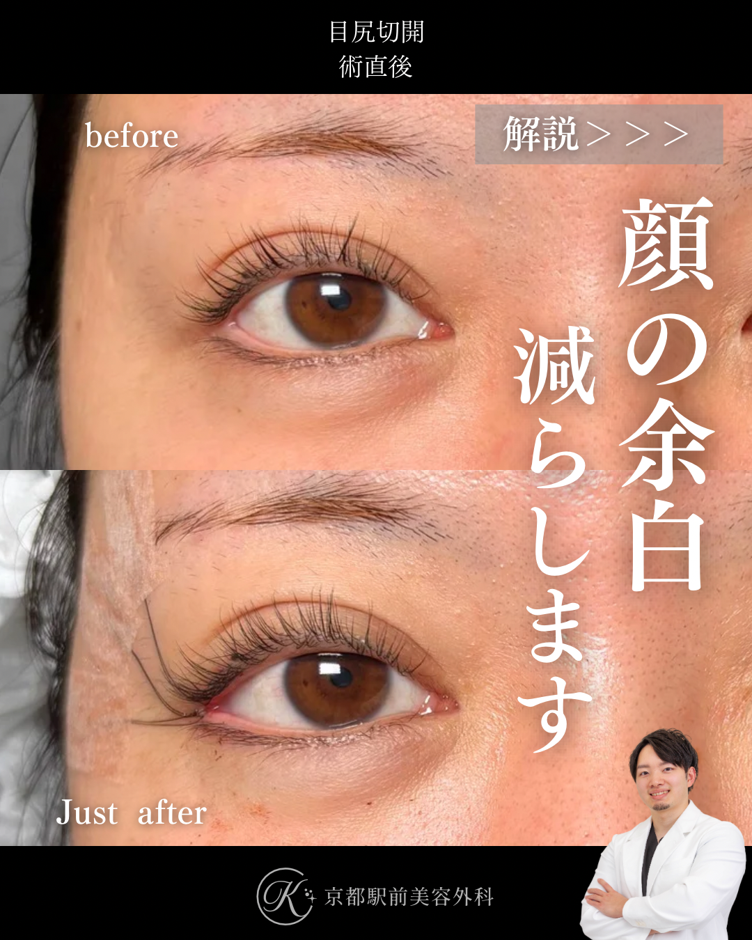 目尻切開の術直後写真（京都駅前美容外科の症例）