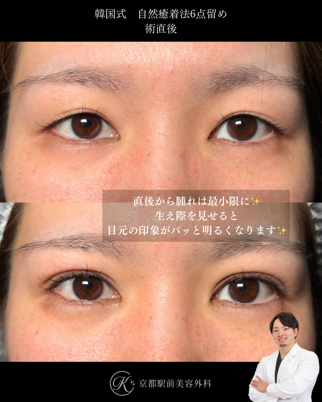 二重埋没法（自然癒着法法6点留め）の術直後写真（京都駅前美容外科の症例）