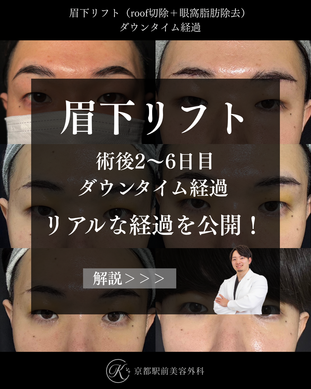 眉下切開（眉下リフト）のダウンタイム経過の写真（roof切除・眼窩脂肪除去）（京都駅前美容外科の目元症例）
