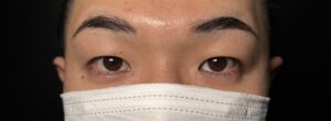 眉下切開の術前写真