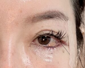 タレ目形成（結膜浮腫）の画像（京都駅前美容外科）