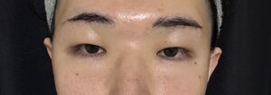 眉下切開の翌日経過
